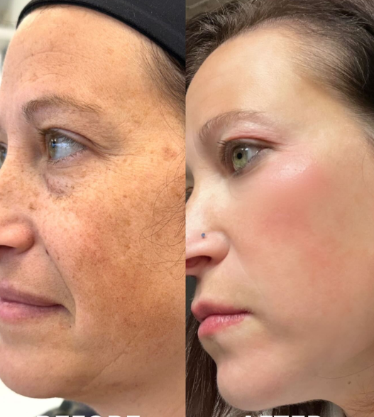 The Power of the Peel. Results from a 3-Step Peel and ZO Regimen, 2 months apart.